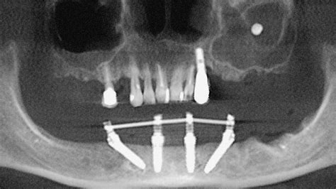 Entfernung eines Aspergilloms aus dem Sinus maxillaris | Quintessenz ...