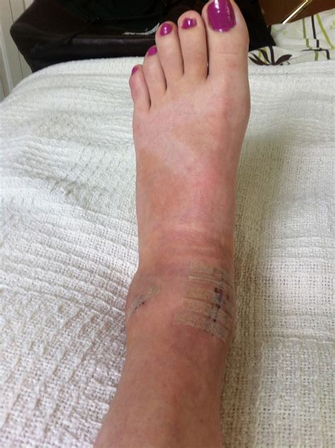 Ankle Fracture Symptoms - Fracture Treatment