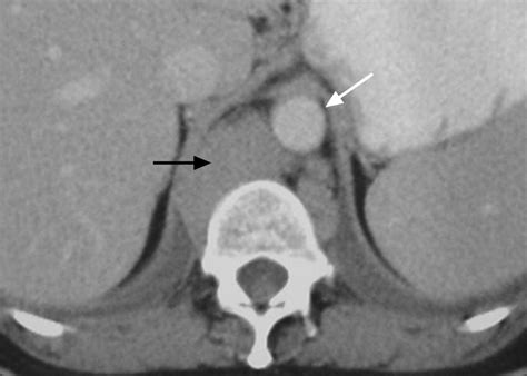 The Diaphragmatic Crura and Retrocrural Space: Normal Imaging ...