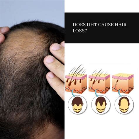 The Science Behind DHT Blocker Results for Hair Fall | Clinikally