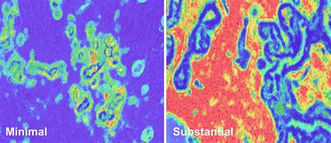 Stromal Disruption Predicts Aggressive Breast Cancer Risk, Survival - NCI