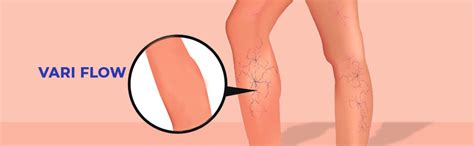 Matsya Veda Vari Flow For Varicose Veins - 60 Capsules : Amazon.in ...