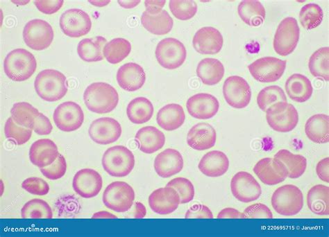 Target Cells with Abnormal Red Blood Cells in Blood Smear Stock Image - Image of hemophilia ...