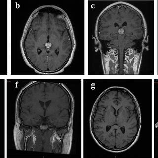 Image result for Intractable Diplopia