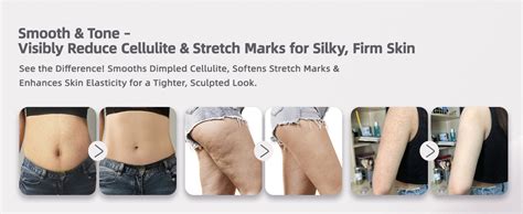 HANNEA Lymphatic Drainage Massager Microcurrent Tool For Cellulite Legs ...