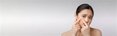 Acne and Pimples Treatment at Skin Secrets Kochi