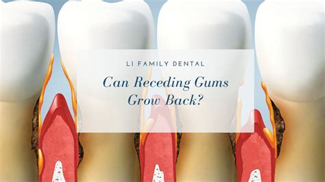 Receding Gums: Causes, Prevention, and Treatment Options