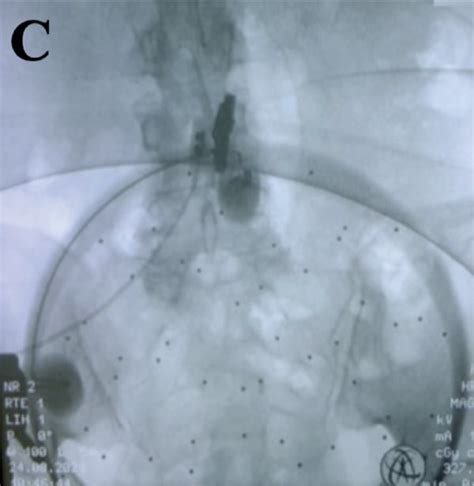 Image result for What Is a Fluoroscopy Injection