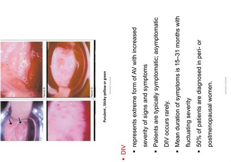 Aerobic Vaginitis | PPT