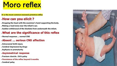 Moro Reflex Testing 的图像结果