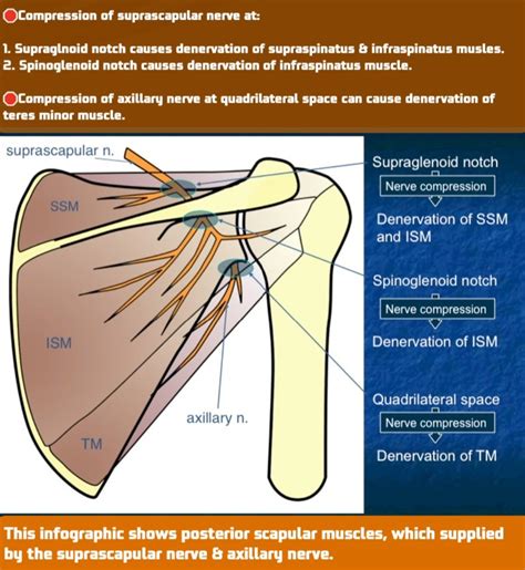 Spinoglenoid Notch