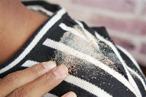 Is Dandruff Contagious? Separating Facts From Fiction For Scalp Health ...