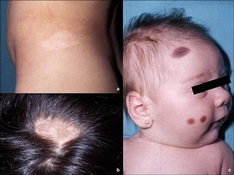 Congenital Nevus Scalp