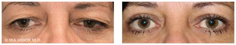 Bildergebnis für blurred vision after blepharoplasty
