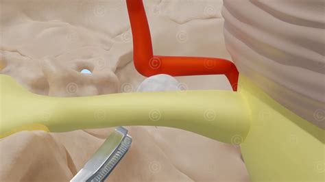 Animation microvascular decompression surgery - MedicalGraphics