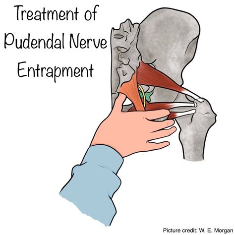 Sacrospinous Ligament Pudendal Nerve