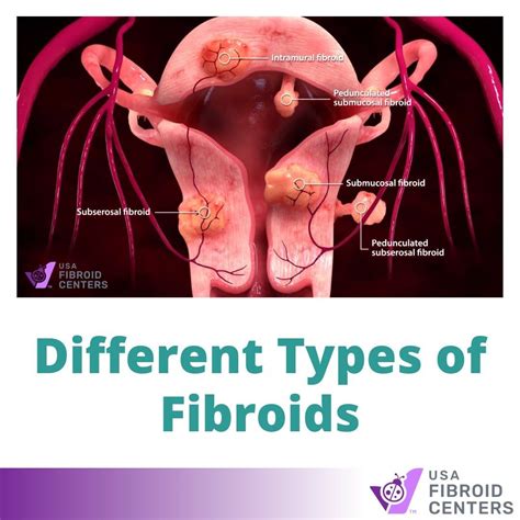 Uterine fibroids during pregnancy symptoms and treatment – Artofit