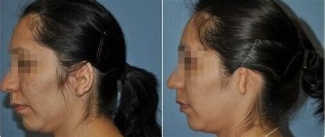 Microtia Surgery Indore, India - Microtia Ear Reconstruction, Repair ...