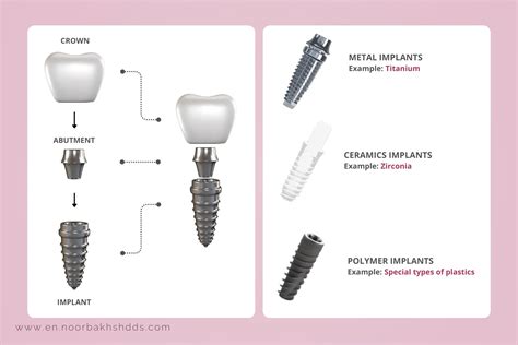 Options For Dental Implants