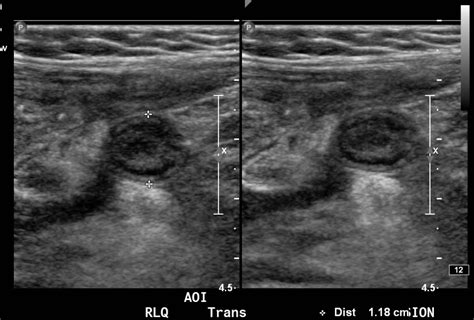 Ruptured Appendix Ultrasound