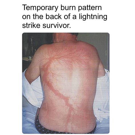Jerry Science | When lightning strikes a human, it can leave behind a ...