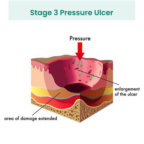 Identifying and Managing a Stage 3 Pressure Ulcer in nursing home