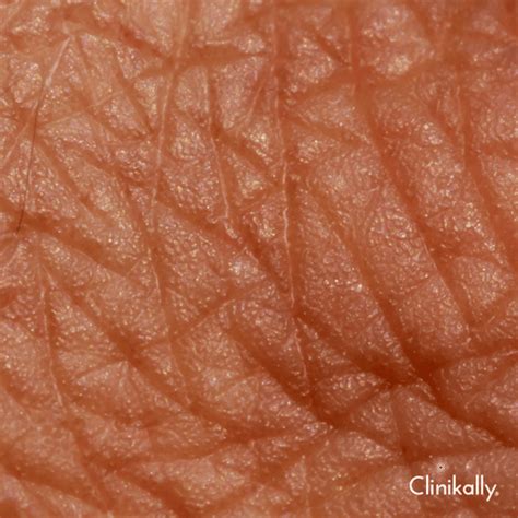 5 Tips to Repair Skin Barrier Damage (Doctor's Guide) | Clinikally