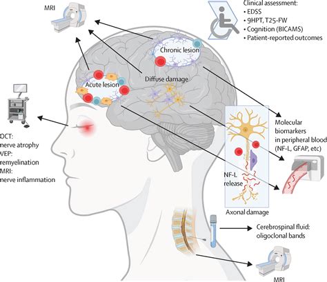 Multiple sclerosis - The Lancet