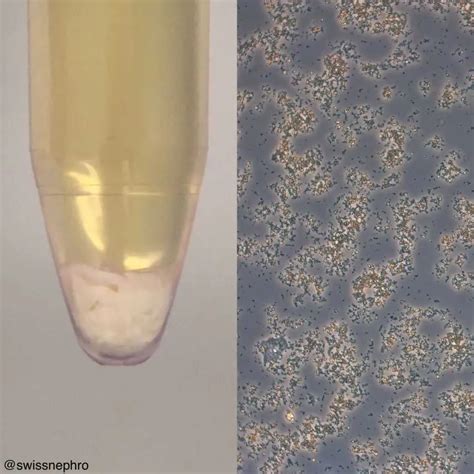 Causes and Treatment of White Specs in Urine
