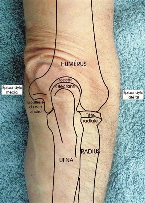 Subdural vs epidural hematoma ct findings location symptoms and pathophysiology – Artofit