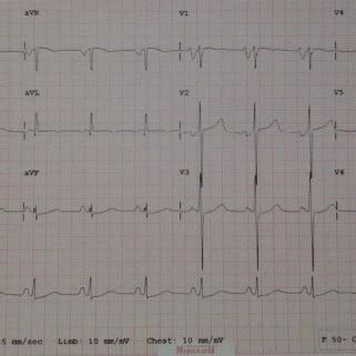 Image result for Counterclockwise Atrial Flutter