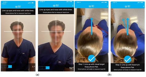 Accuracy of Measurement Tools for Ocular-Origin Anomalous Head Posture ...