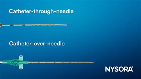 Understanding perineural catheter designs: Which one is right for your practice? - NYSORA