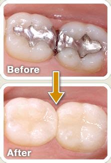 Treatments -> Dental Fillings / Restorations - Dr. Prachi Patil's ...