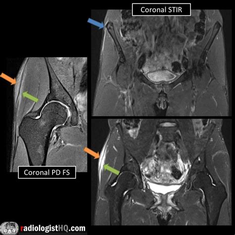 Iliotibial Band Syndrome Mri