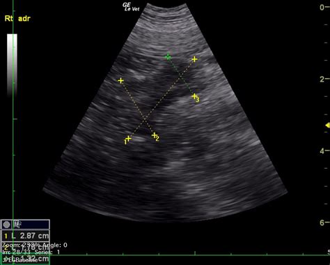07_00164 Zoe J Adrenal gland mass - Members