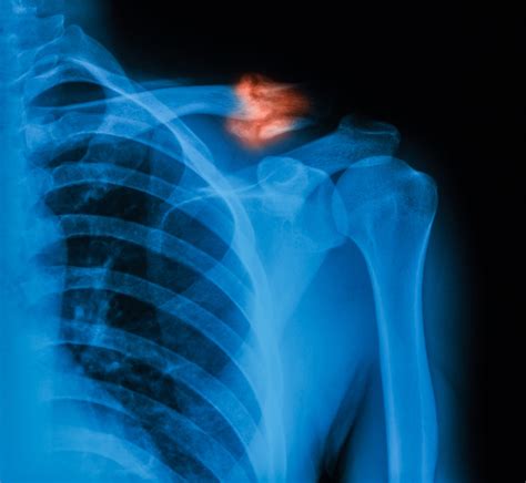 Clavicle Fracture Treatment and Healing - Fracture Healing