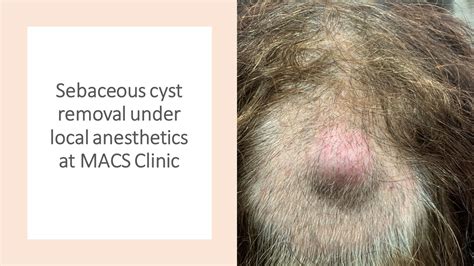 Image result for Sebaceous Cyst On Back