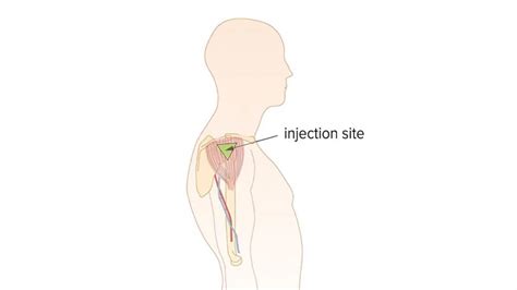 Image result for Injection Sites