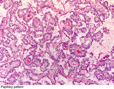 Pathology Outlines - Yolk sac tumor