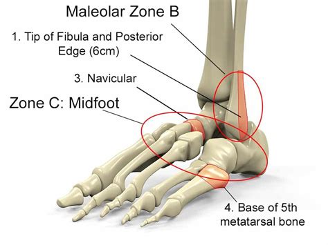 How To Tell If Your Ankle Is Broken Quiz - howsolut