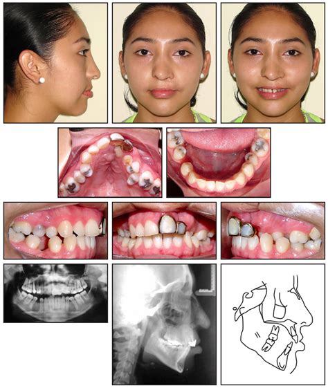 Cleft Lip And Palate Adults