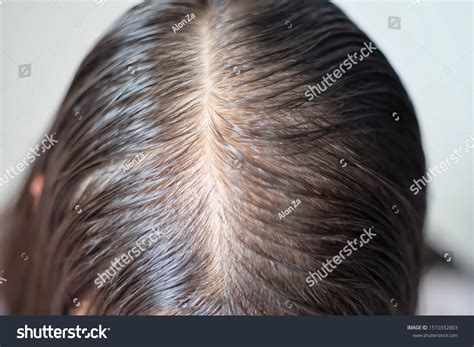1,148 imágenes de Scalp images - Imágenes, fotos y vectores de stock ...