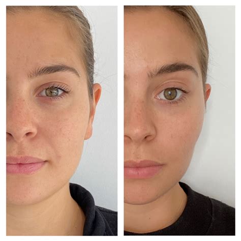 Botox for Jaw Pain - Grazia