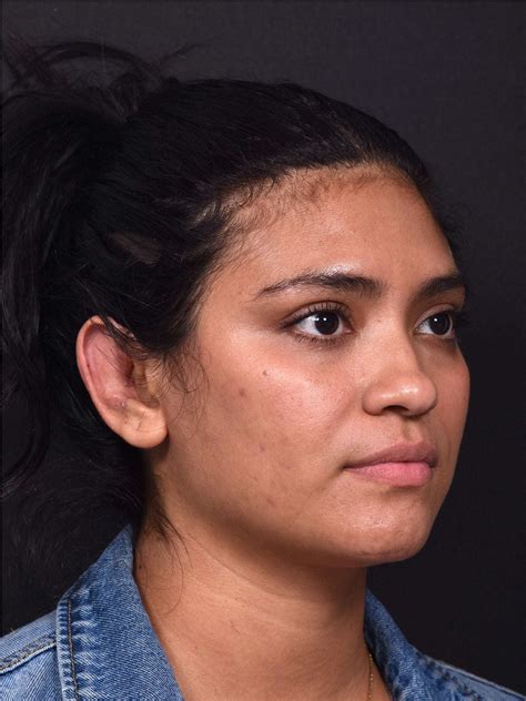 Otoplasty Case 11115