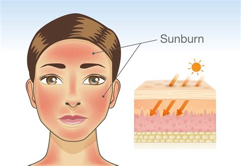 Sunburn - Publications, News and Products about Sunburn in CredoWeb