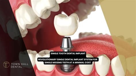 Single Tooth Dental Implant - Restore Your Smile | Town Hall Dental