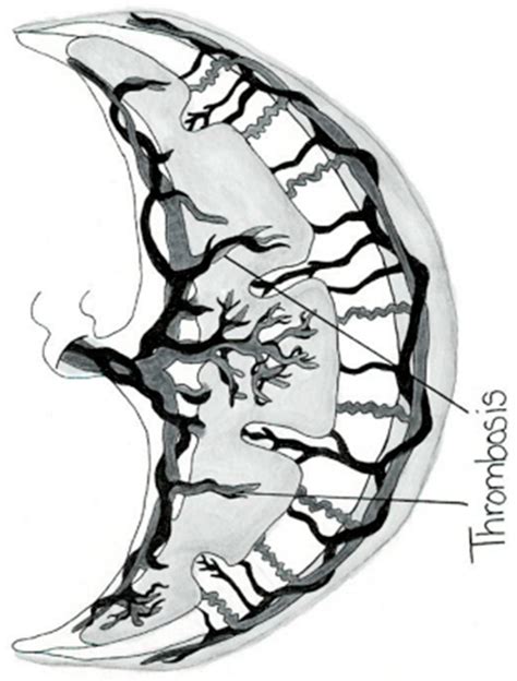 What Is the Significance of Placental Lakes in Pregnancy? A Historic ...