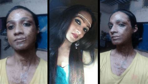 Telangana transgender woman, who is also an acid attack survivor, to ...