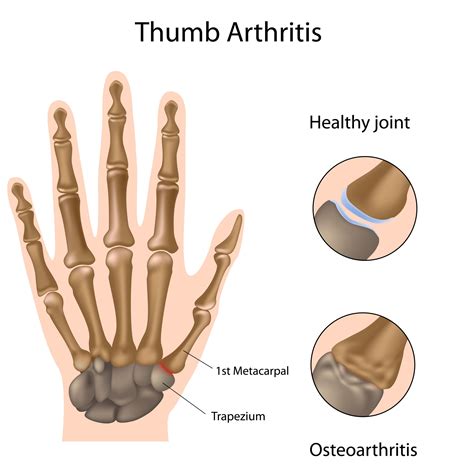 Thumb Arthritis – Causes, Symptoms and Treatment - Apollo Hospitals